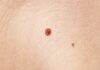 Skin Tags