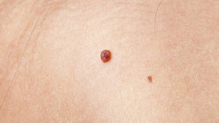 Skin Tags