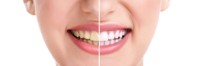 The Benefits of Professional Teeth Whitening